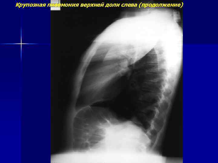 Крупозная пневмония верхней доли слева (продолжение) 
