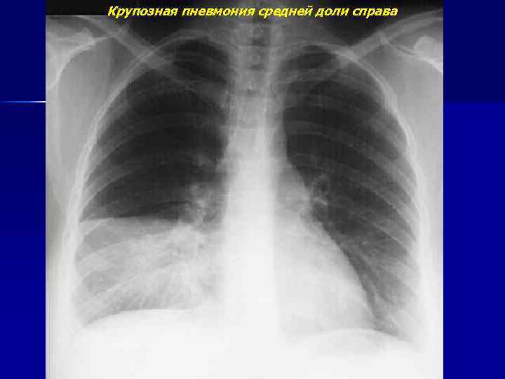 Крупозная пневмония средней доли справа 