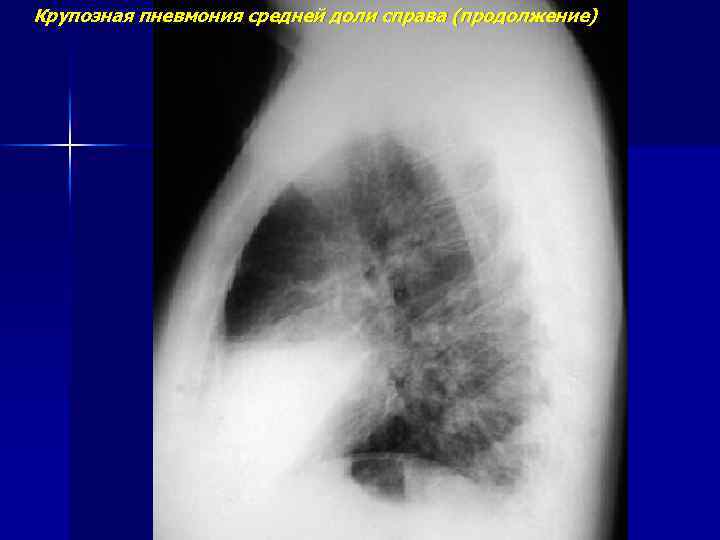 Крупозная пневмония средней доли справа (продолжение) 