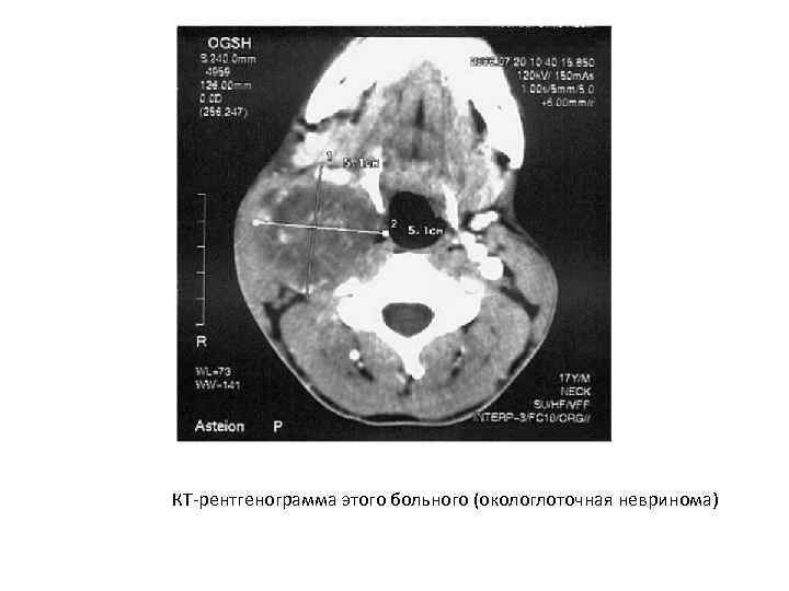 КТ-рентгенограмма этого больного (окологлоточная невринома) 