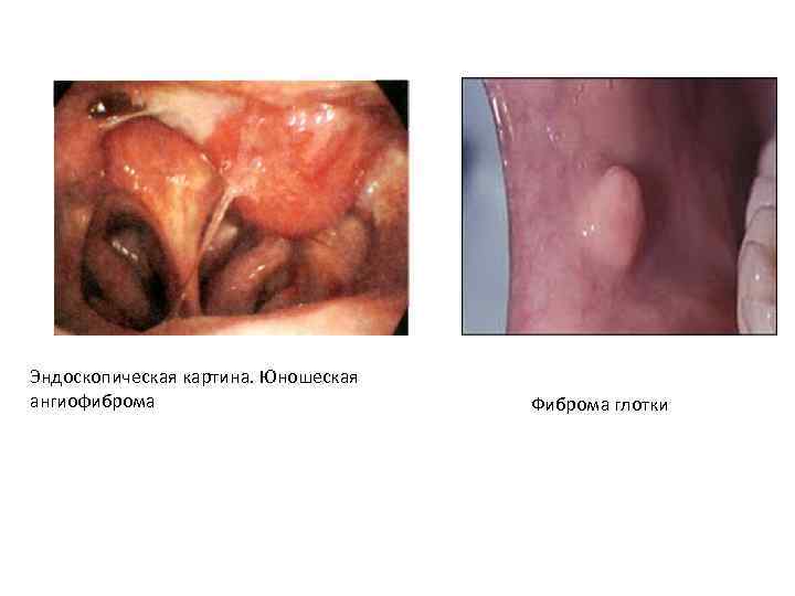 Эндоскопическая картина. Юношеская ангиофиброма Фиброма глотки 