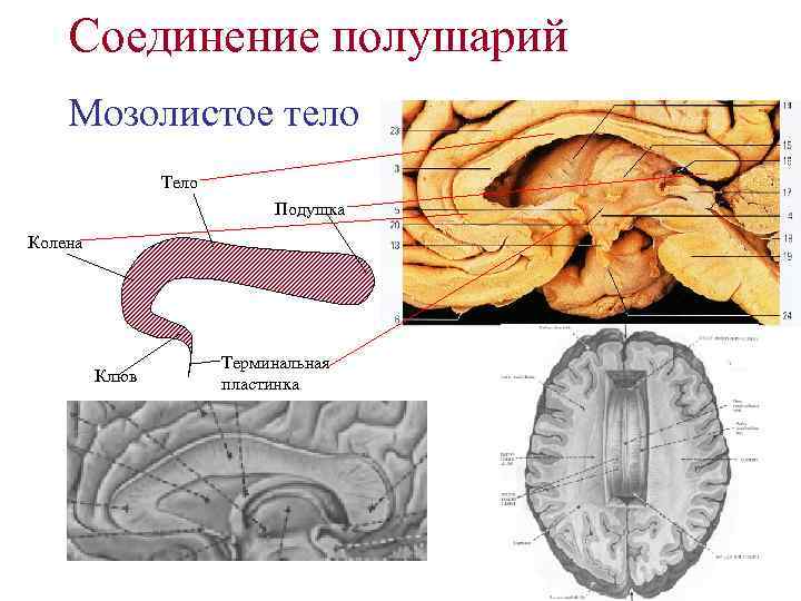 Соединение полушарий Мозолистое тело Тело Подушка Колена Клюв Терминальная пластинка 