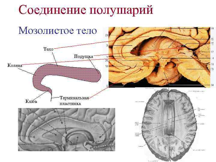 Мозолистое тело какая ткань