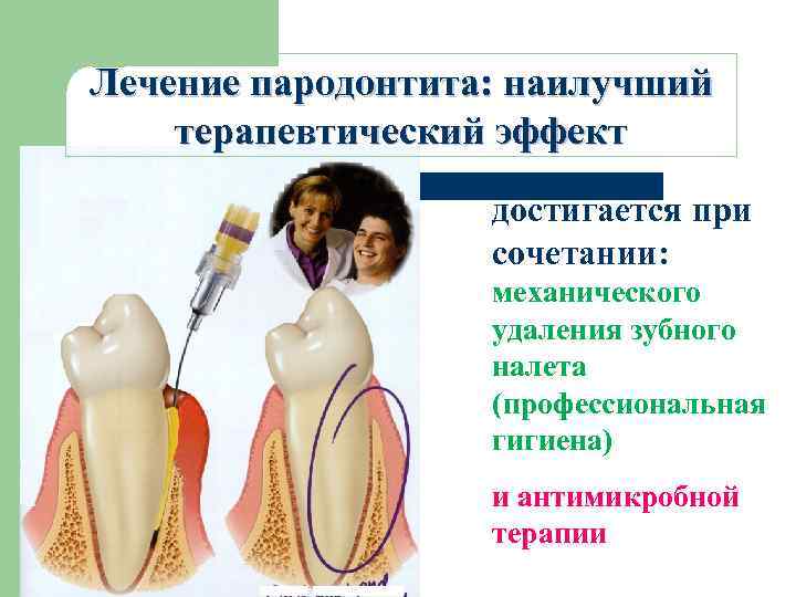 Лечение пародонтита: наилучший терапевтический эффект достигается при сочетании: механического удаления зубного налета (профессиональная гигиена)