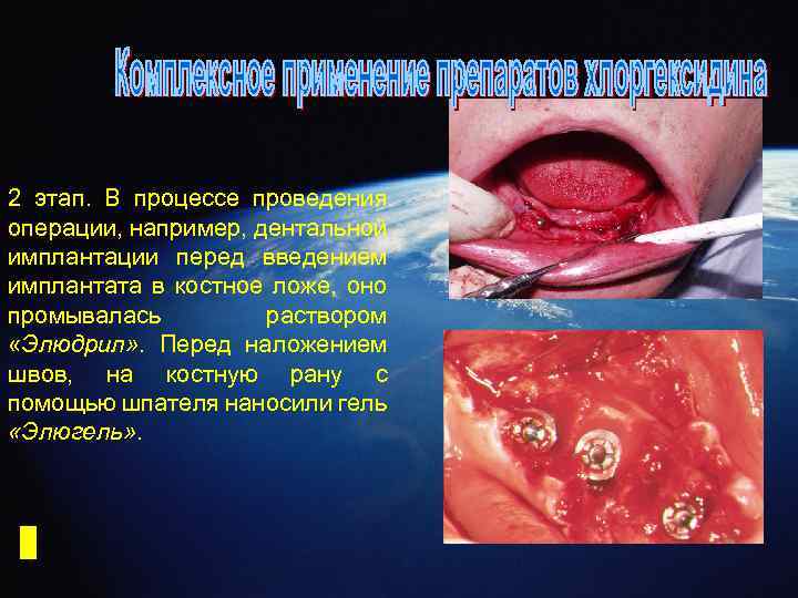 2 этап. В процессе проведения операции, например, дентальной имплантации перед введением имплантата в костное