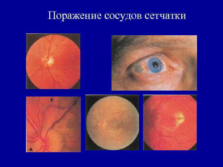 Поражение сосудов сетчатки 