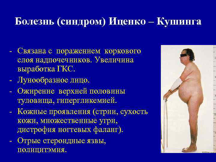 Болезнь (синдром) Иценко – Кушинга - Связана с поражением коркового слоя надпочечников. Увеличина выработка