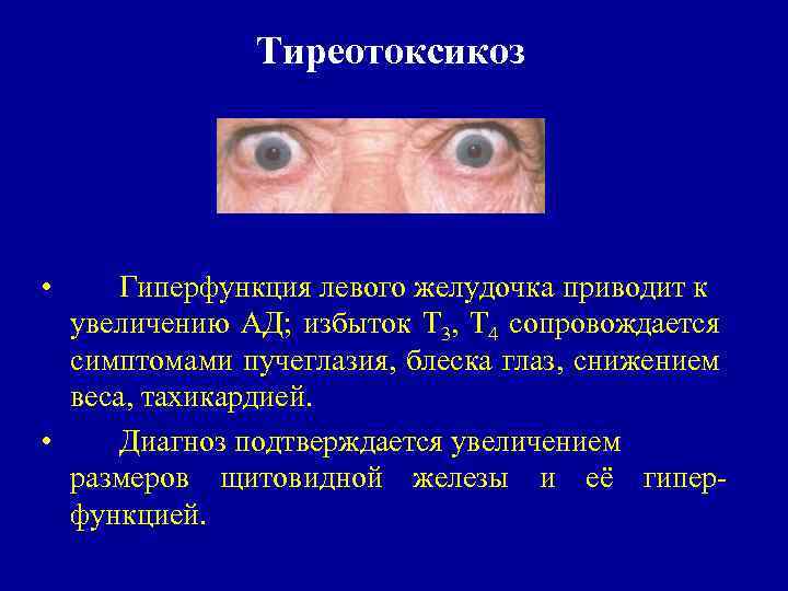 Тиреотоксикоз • Гиперфункция левого желудочка приводит к увеличению АД; избыток Т 3, Т 4