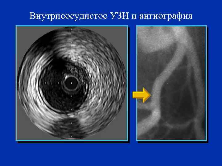 Внутрисосудистое УЗИ и ангиография 