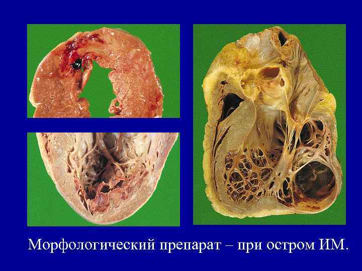 Морфологический препарат – при остром ИМ. 