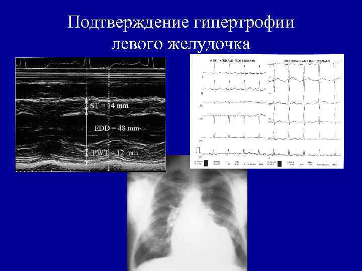 Подтверждение гипертрофии левого желудочка 