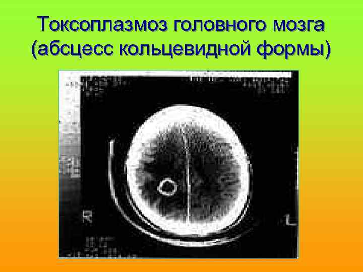 Токсоплазмоз головного мозга (абсцесс кольцевидной формы) 