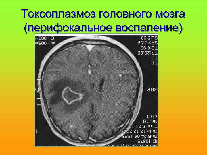 Токсоплазмоз головного мозга кт картина