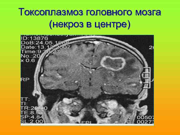 Токсоплазмоз головного мозга (некроз в центре) 