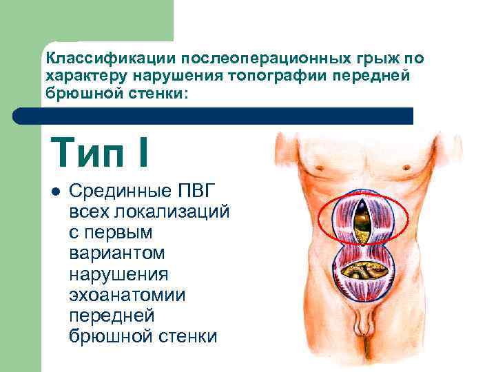 Классификации послеоперационных грыж по характеру нарушения топографии передней брюшной стенки: Тип I l Срединные
