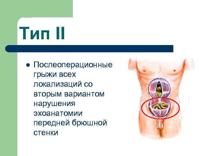 Тип II l Послеоперационные грыжи всех локализаций со вторым вариантом нарушения эхоанатомии передней брюшной
