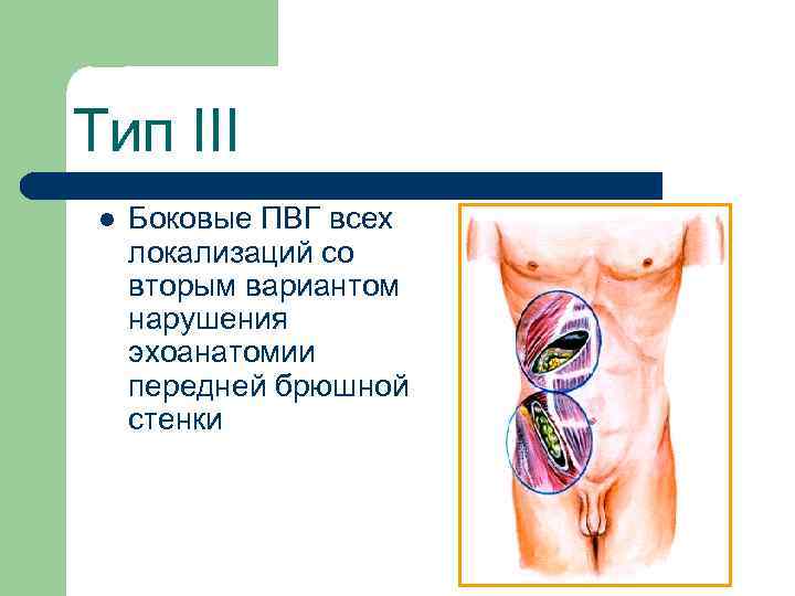 Тип III l Боковые ПВГ всех локализаций со вторым вариантом нарушения эхоанатомии передней брюшной