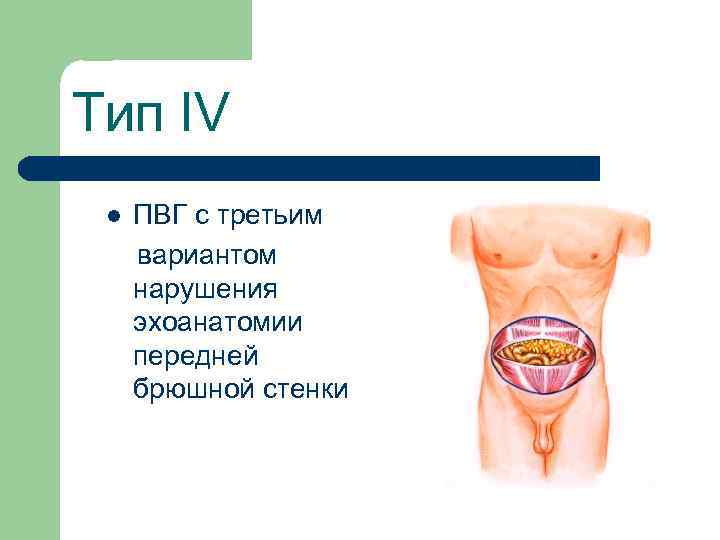Тип IV l ПВГ с третьим вариантом нарушения эхоанатомии передней брюшной стенки 