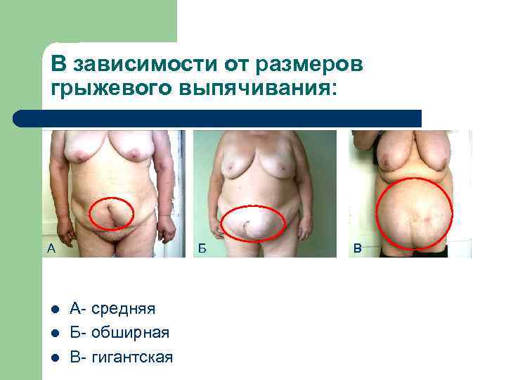 В зависимости от размеров грыжевого выпячивания: А l l l Б А- средняя Б-