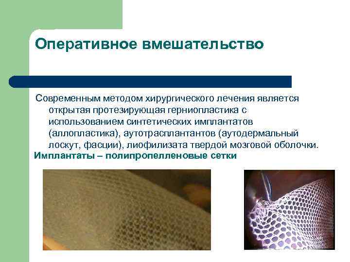 Оперативное вмешательство Современным методом хирургического лечения является открытая протезирующая герниопластика с использованием синтетических имплантатов