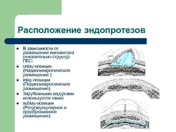 Расположение эндопротезов l l l В зависимости от размещения имплантата относительно структур ПБС: onlay-позиция