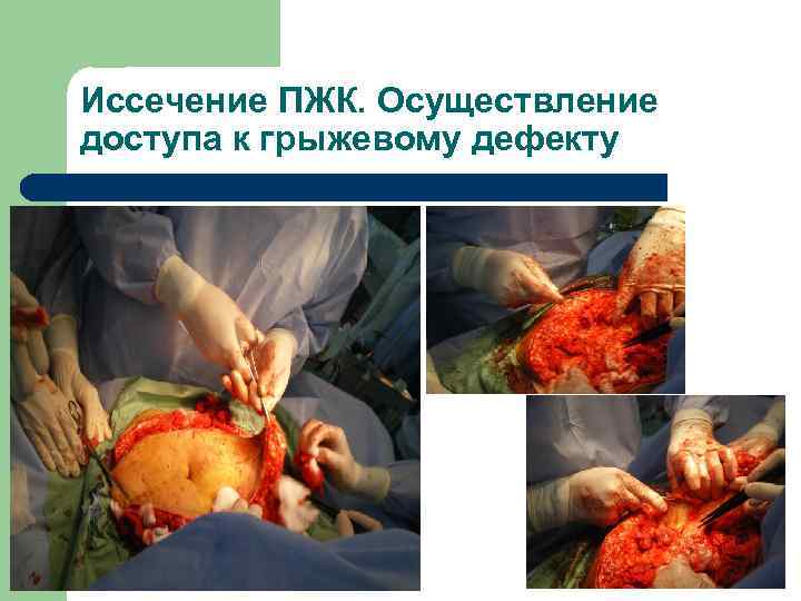 Иссечение ПЖК. Осуществление доступа к грыжевому дефекту 
