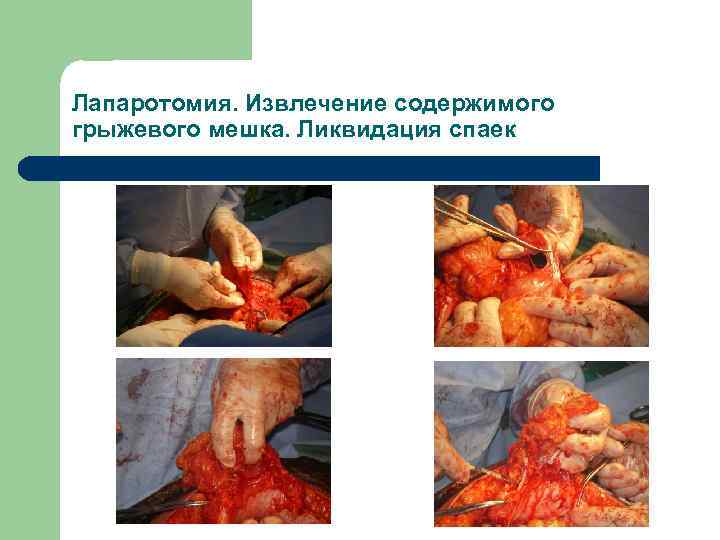 Лапаротомия. Извлечение содержимого грыжевого мешка. Ликвидация спаек 