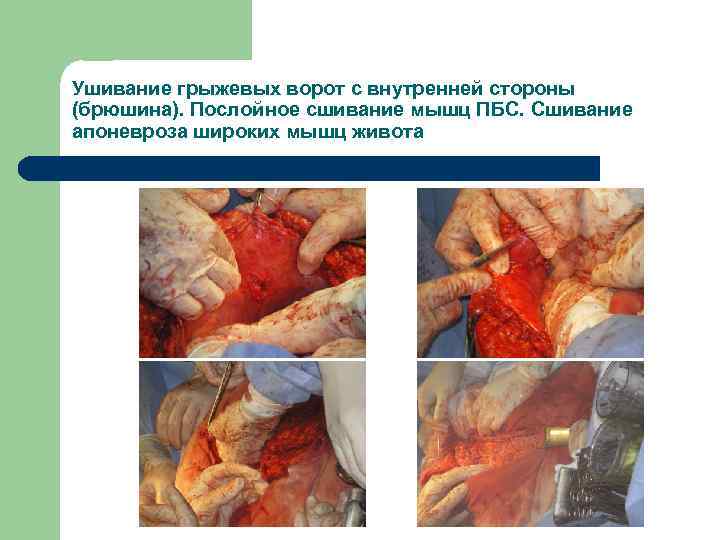 Ушивание грыжевых ворот с внутренней стороны (брюшина). Послойное сшивание мышц ПБС. Сшивание апоневроза широких