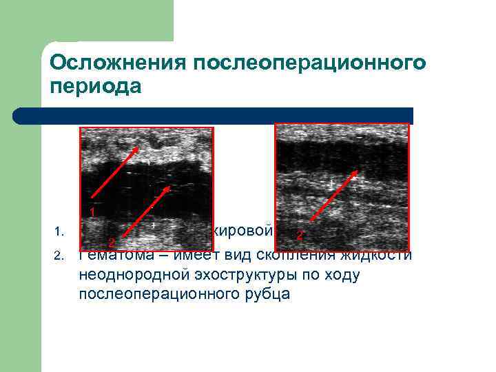 Осложнения послеоперационного периода 1 1. 2. Отек подкожной жировой клетчатки 2 2 Гематома –
