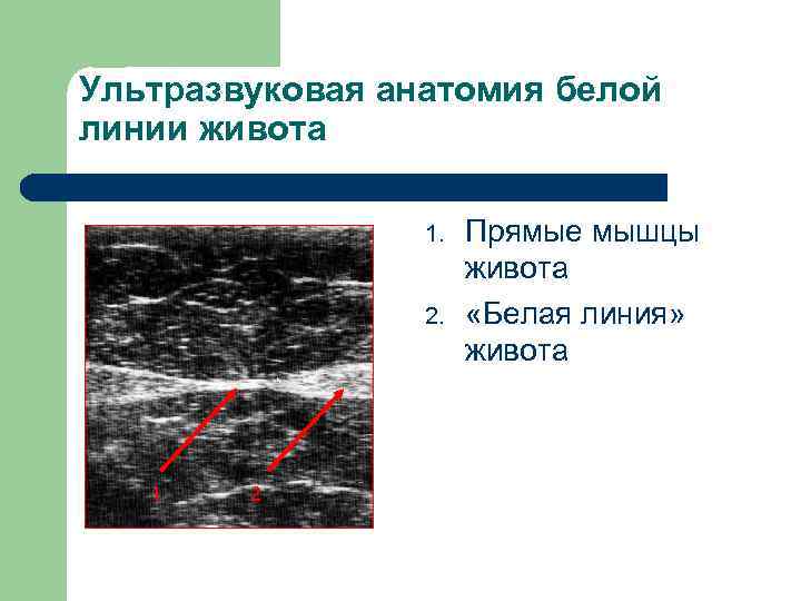 Ультразвуковая анатомия белой линии живота 1. 2. 1 2 Прямые мышцы живота «Белая линия»