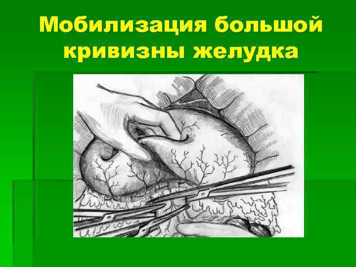 Мобилизация большой кривизны желудка 