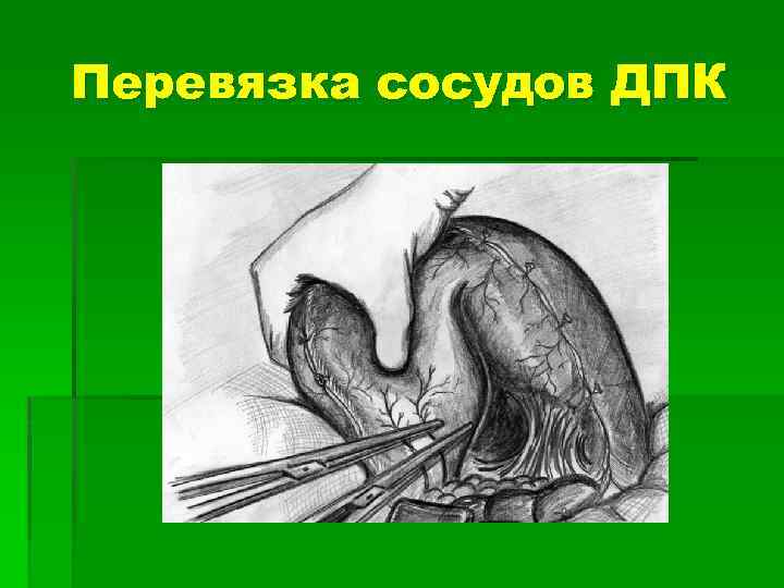 Перевязка сосудов ДПК 