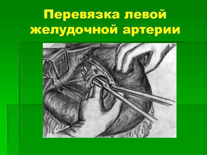 Перевязка левой желудочной артерии 