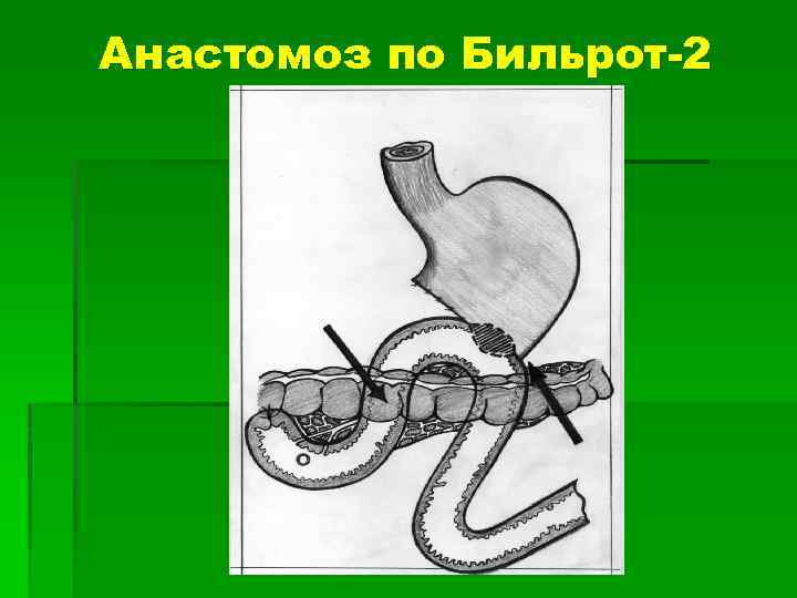 Анастомоз по Бильрот-2 