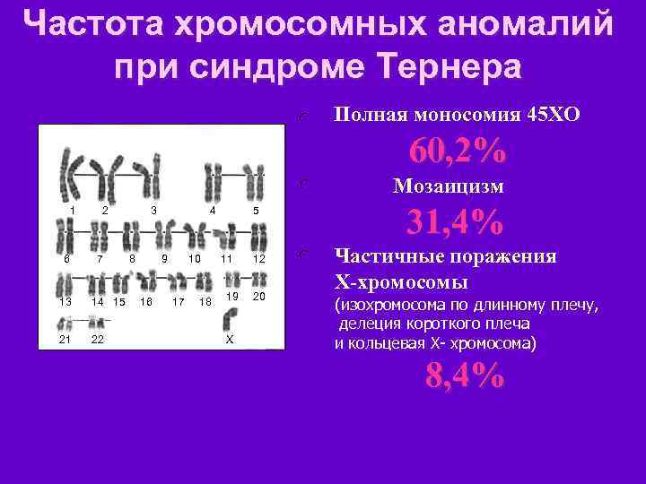 Частота хромосомных аномалий при синдроме Тернера l Полная моносомия 45 ХО 60, 2% l