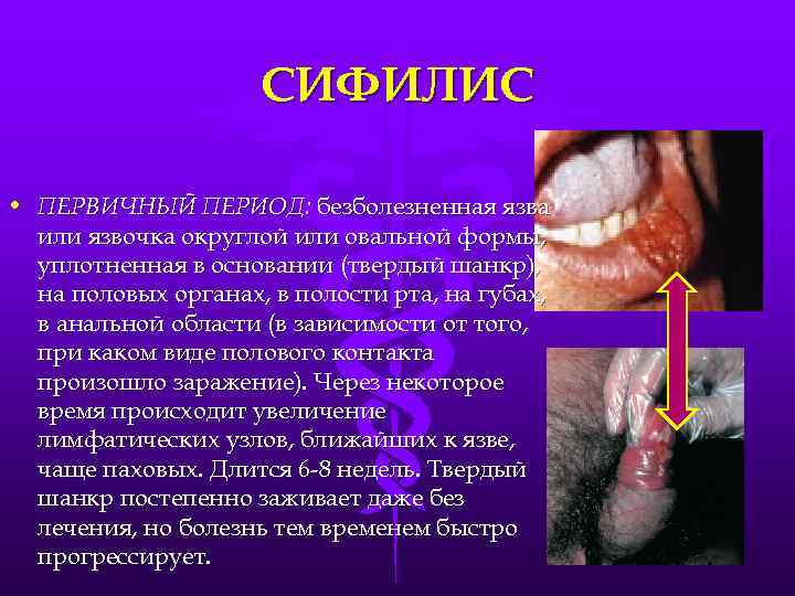 СИФИЛИС • ПЕРВИЧНЫЙ ПЕРИОД: безболезненная язва или язвочка округлой или овальной формы, уплотненная в