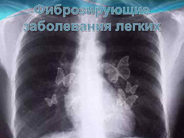 Фиброзирующие заболевания легких 