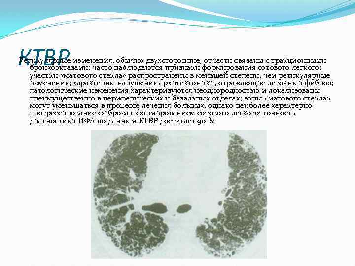 КТВР Ретикулярные изменения, обычно двухсторонние, отчасти связаны с тракционными бронхоэктазами; часто наблюдаются признаки формирования