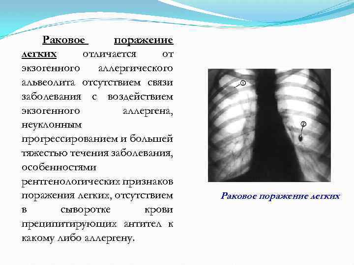 Какая рентгенологическая картина характерна для альвеолитов