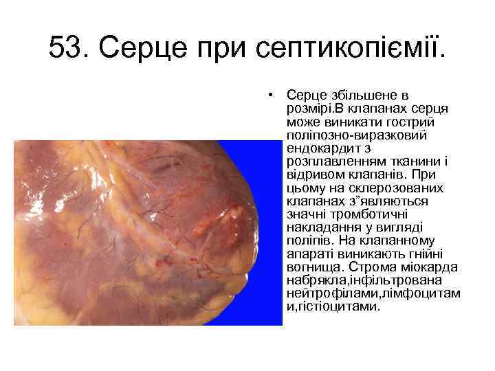 53. Серце при септикопіємії. • Серце збільшене в розмірі. В клапанах серця може виникати