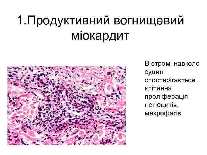 1. Продуктивний вогнищевий міокардит В стромі навколо судин спостерігається клітинна проліферація гістіоцитів, макрофагів 