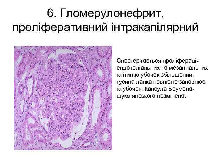 6. Гломерулонефрит, проліферативний інтракапілярний Спостерігається проліферація ендотеліальних та мезангіальних клітин, клубочок збільшений, гусина лапка