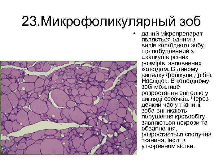 23. Микрофоликулярный зоб • даний мікропрепарат являється одним з видів колоїдного зобу, що побудований