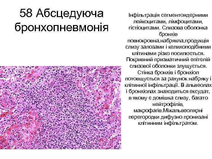 58 Абсцедуюча бронхопневмонія Інфільтрація сегментоядерними лейкоцитами, лімфоцитами, гістіоцитами. Слизова оболонка бронхів повнокровна, набрякла, продукція