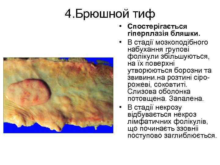 4. Брюшной тиф • Спостерігається гіперплазія бляшки. • В стадії мозкоподібного набухання групові фолікули