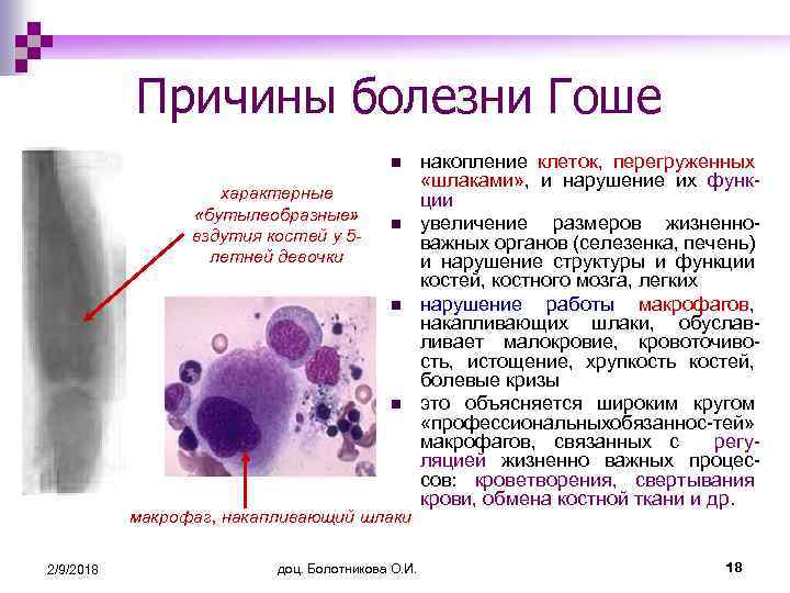 Болезнь гоше. Болезнь Гоше клинические проявления. Болезнь Гоше 1 типа клинические проявления. Клетки Гоше в костном мозге.