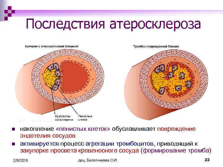 Последствия атеросклероза n n накопление «пенистых клеток» обуславливает повреждение эндотелия сосудов активируется процесс агрегации