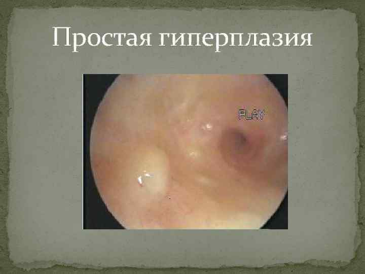 Простая гиперплазия 