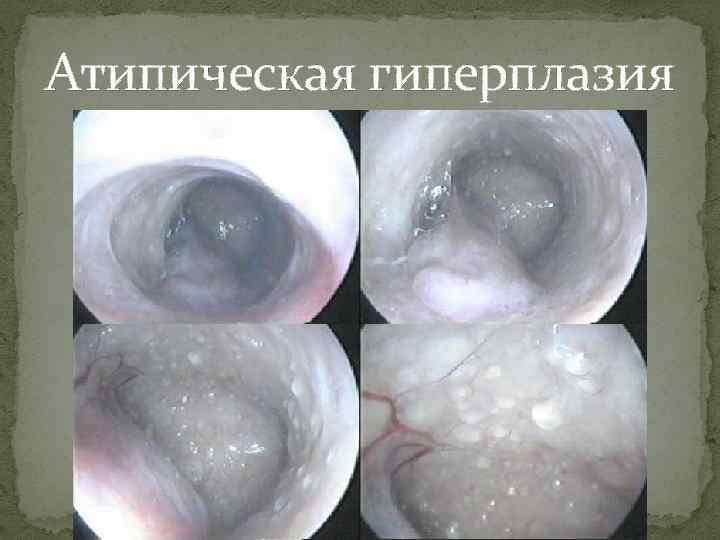 Атипическая гиперплазия 