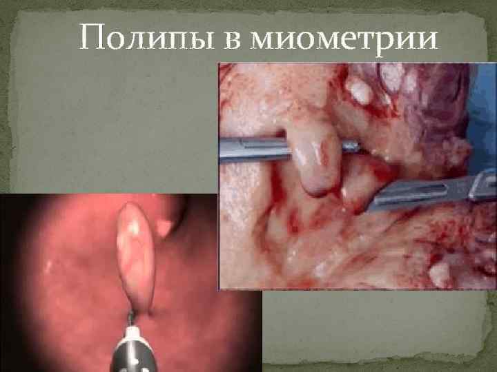 Полипы в миометрии 